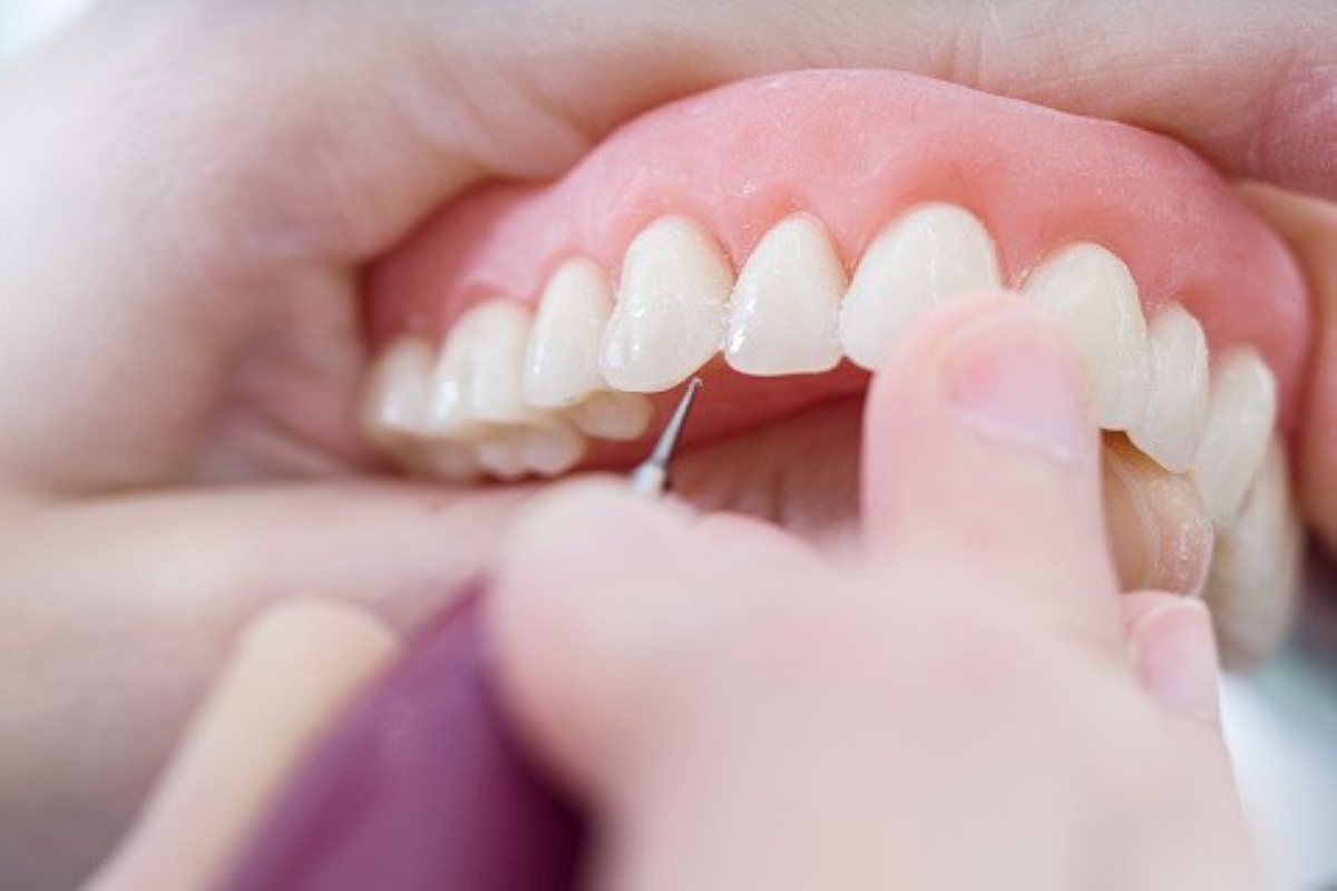 En quoi consiste le rebasage dentaire ?
