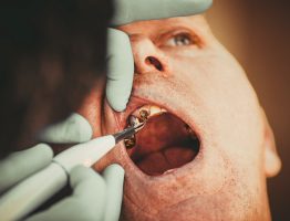Nécrose dentaire : causes, symptômes et traitement