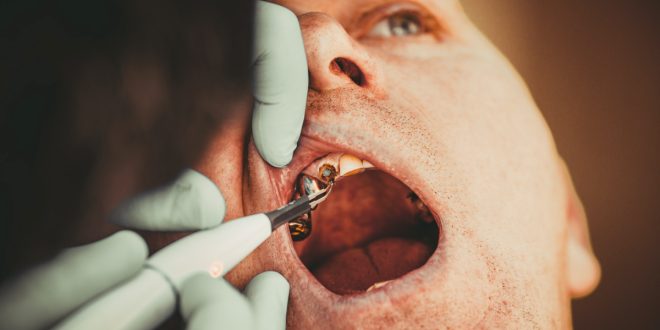 Nécrose dentaire : causes, symptômes et traitement