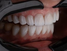 FAQ sur le déchaussement dentaire
