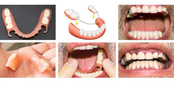 Prothèses dentaires partielles : fonctionnement et critères de choix