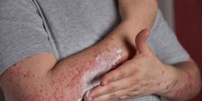 Eczéma et dermatite atopique : astuces pour apaiser les démangeaisons et irritations
